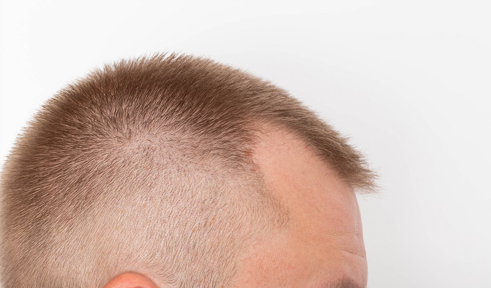 balding male
