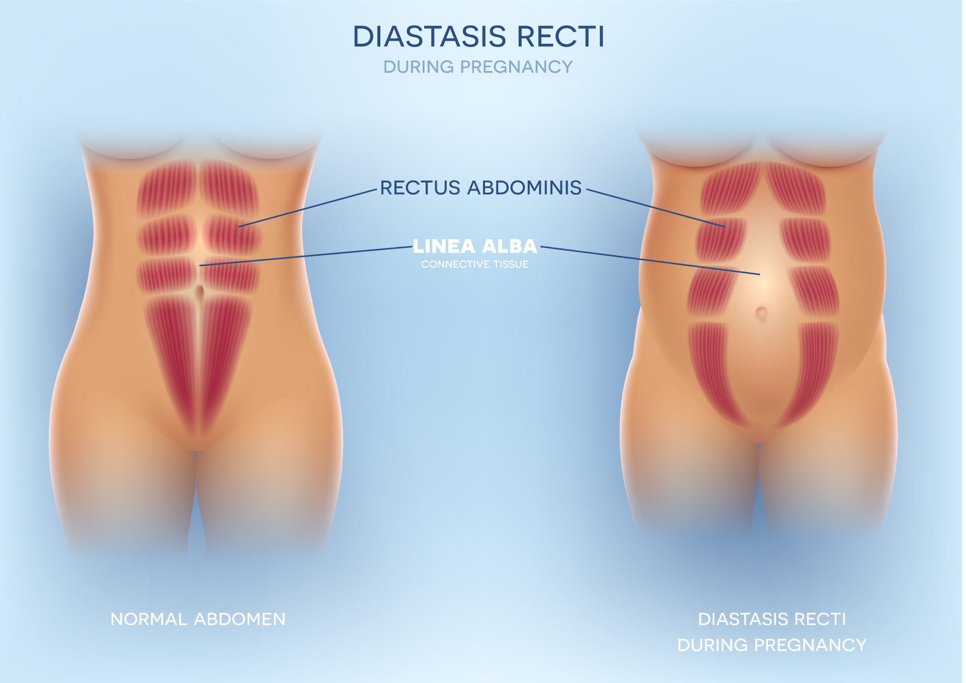 diastatis recti pregnant