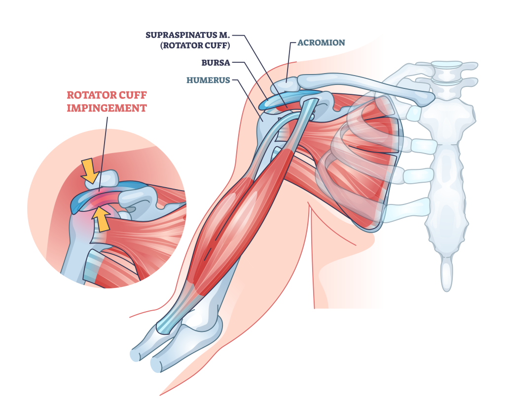 rotator cuff impingement