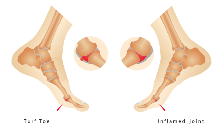 turf toe