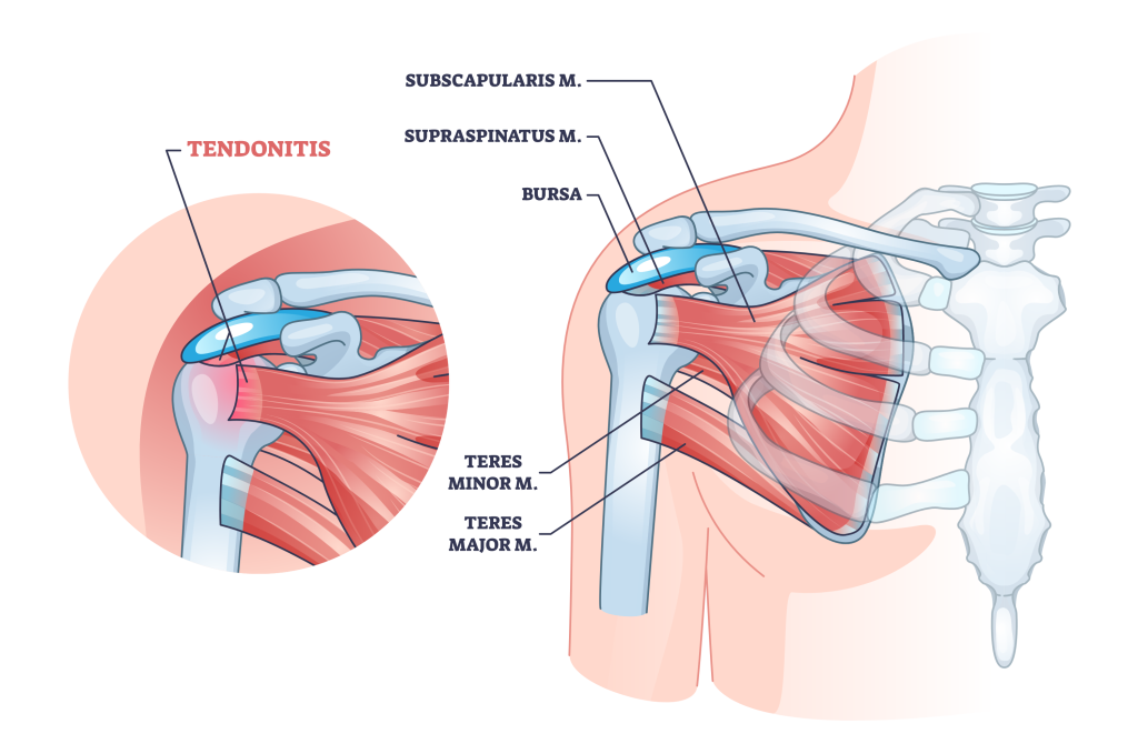 shoulder tendonitis