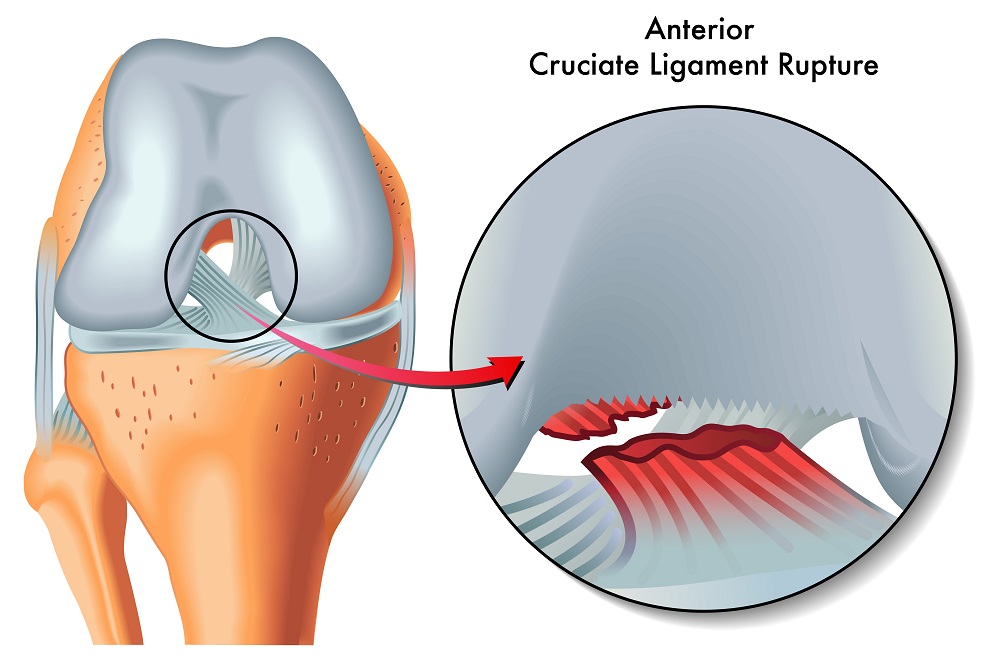 what is acl surgery