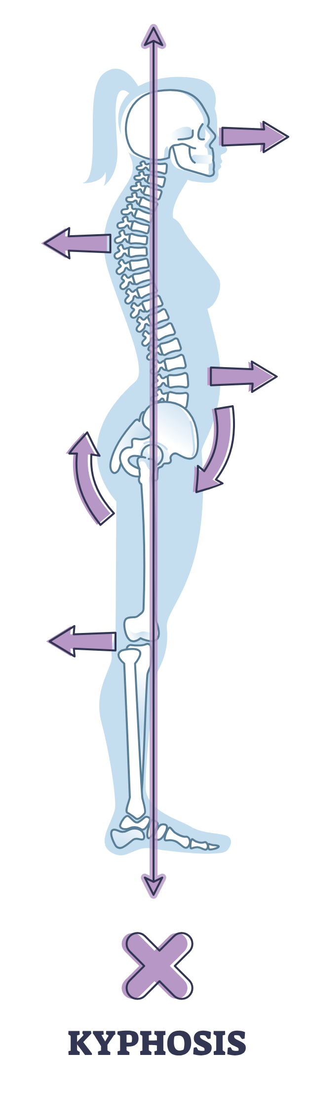 kyphosis