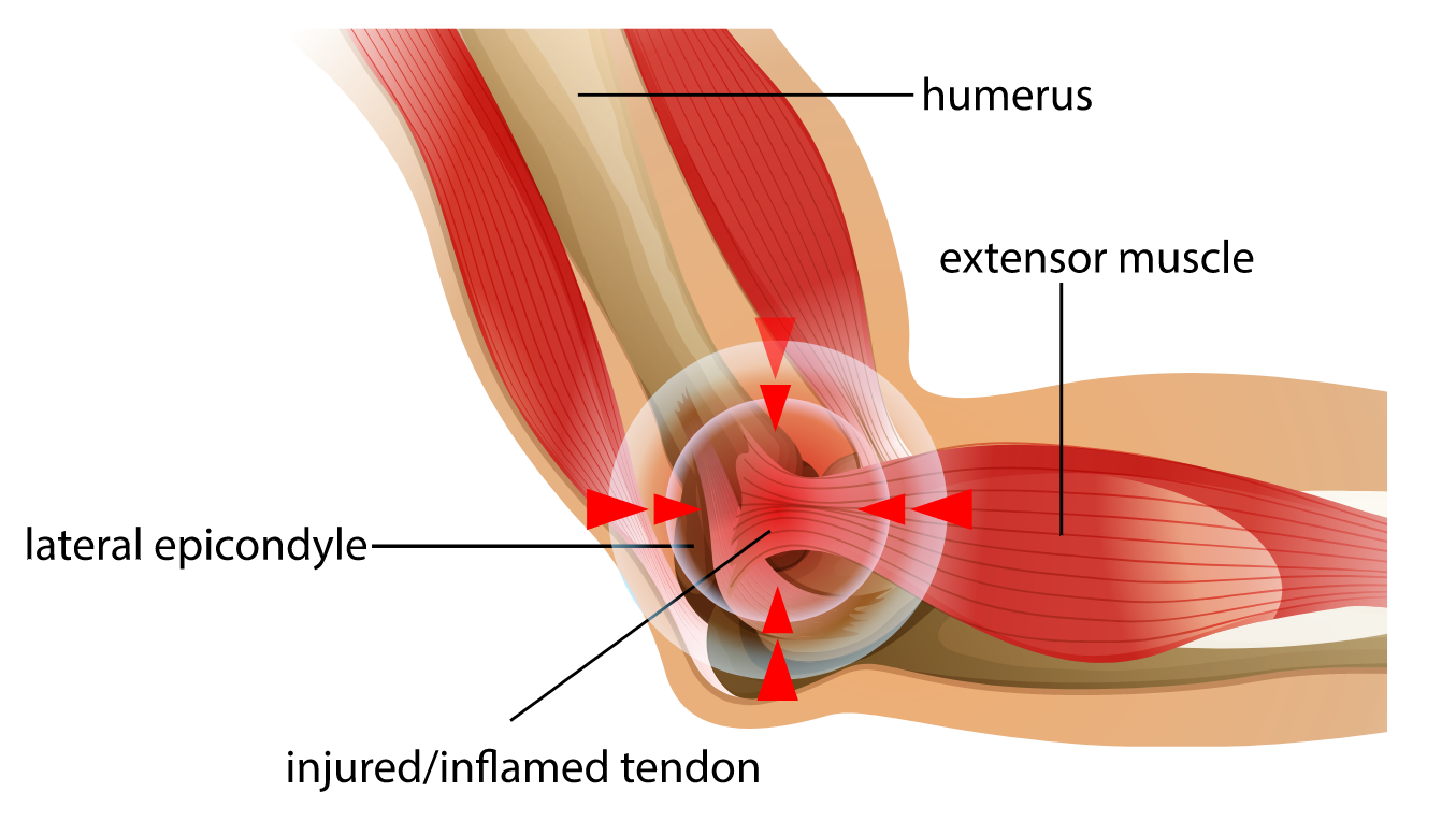 lateral epicondylitis