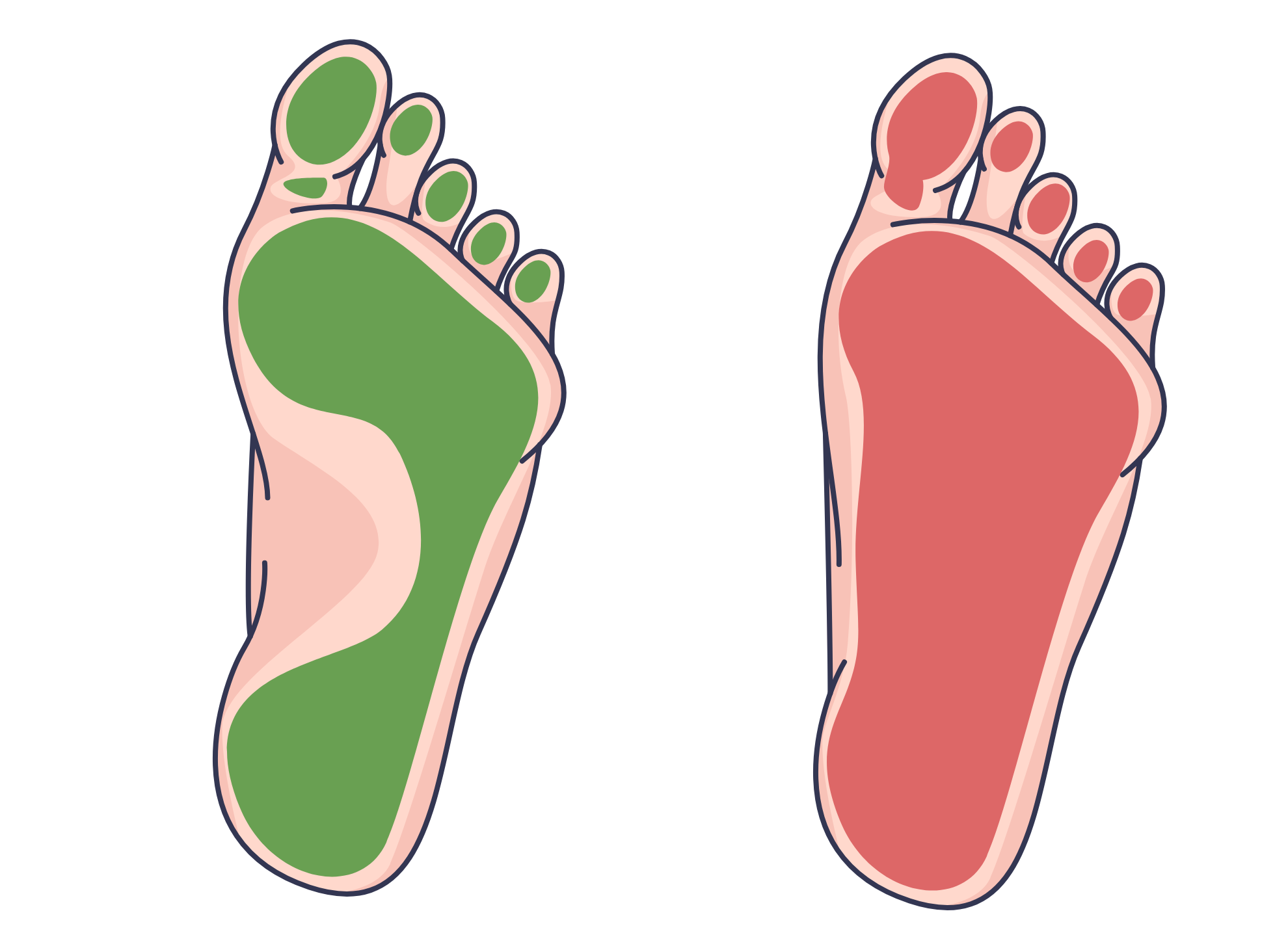 normal foot arch vs flat foot