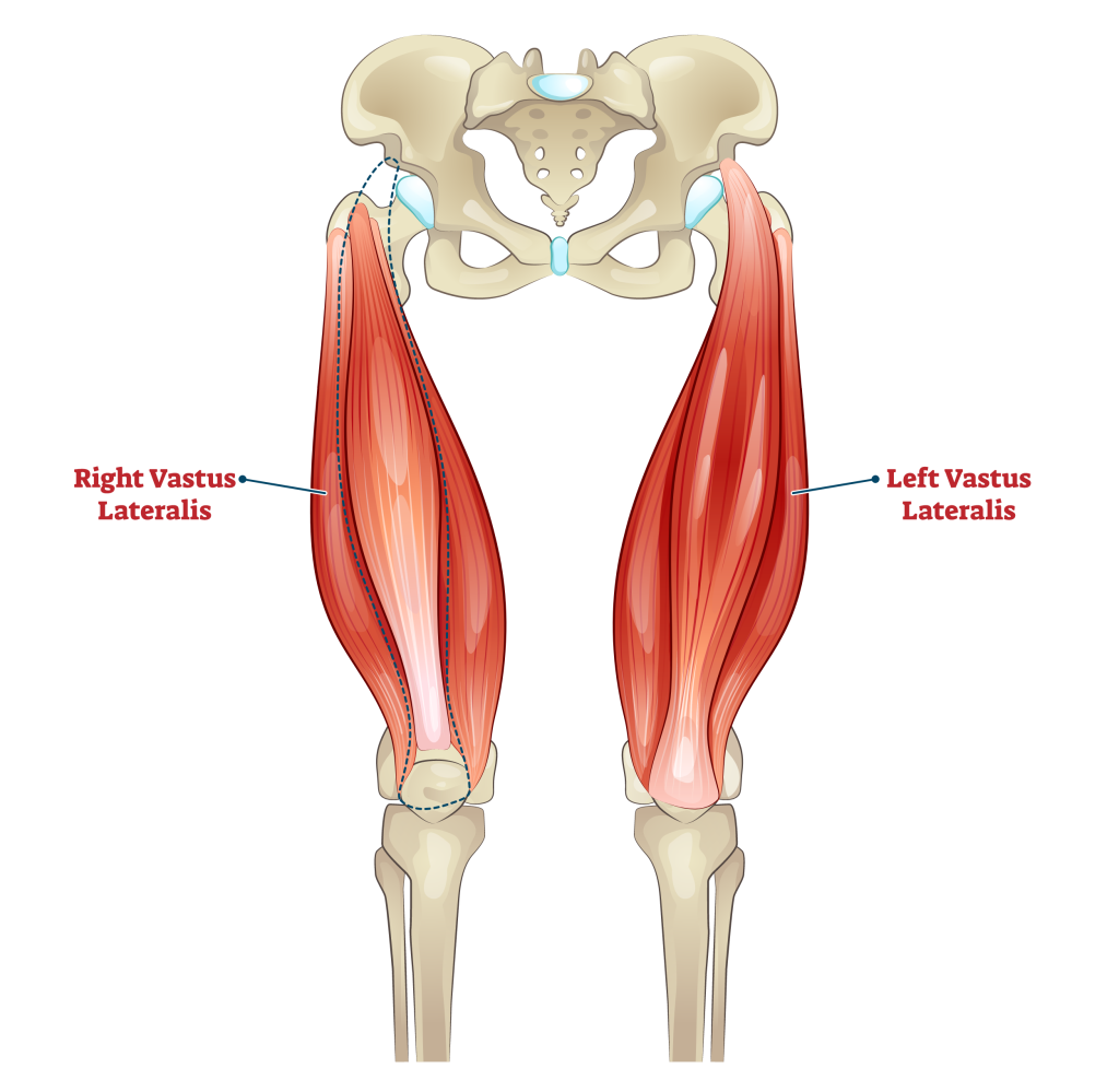 vastus lateralis muscle