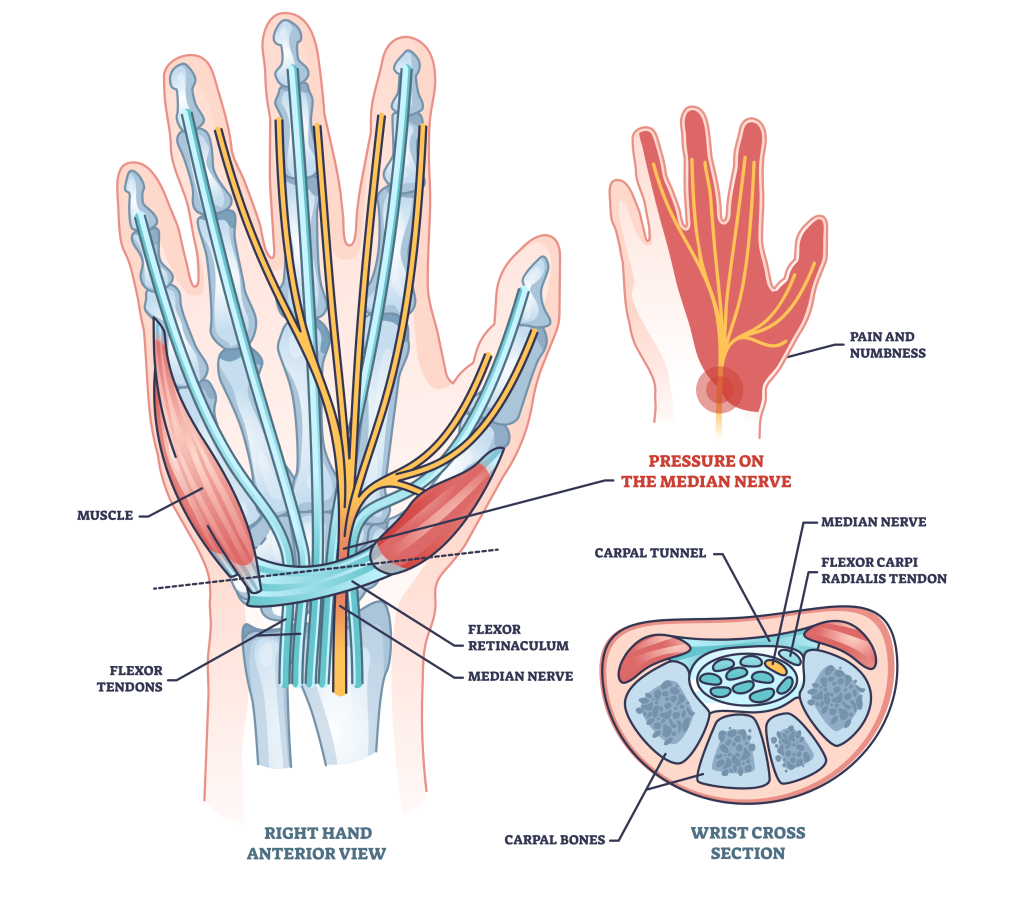 carpal tunnel syndrome