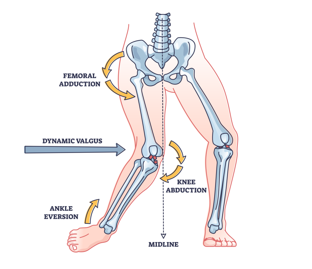 mechanism of acl inury