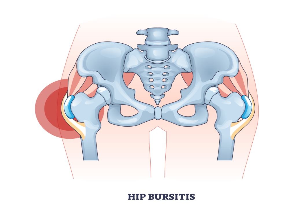 hip bursitis